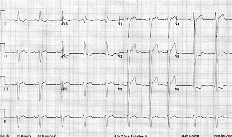 ecg lv hypertrophy|left ventricular hypertrophy life in the fast lane.